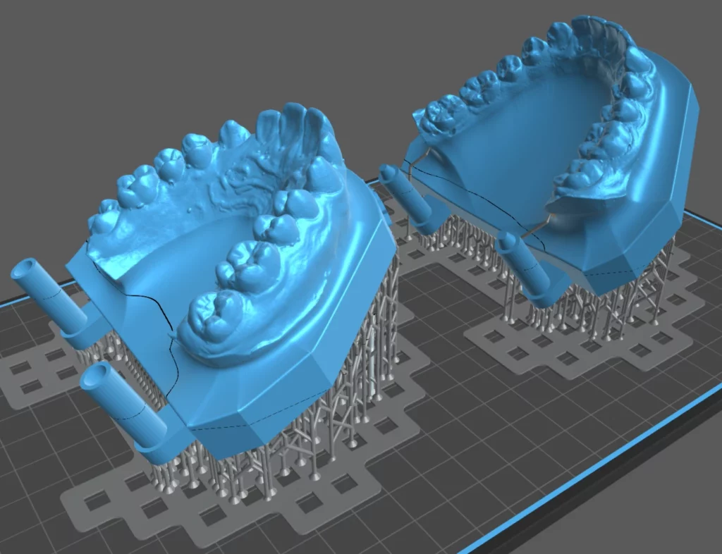 Modèles dentaires issus d'un scan 3D, préparés pour l'impression en résine avec leurs supports